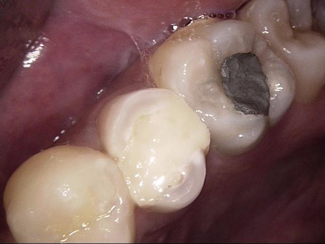 Teeth 25 and 26 at today's visit