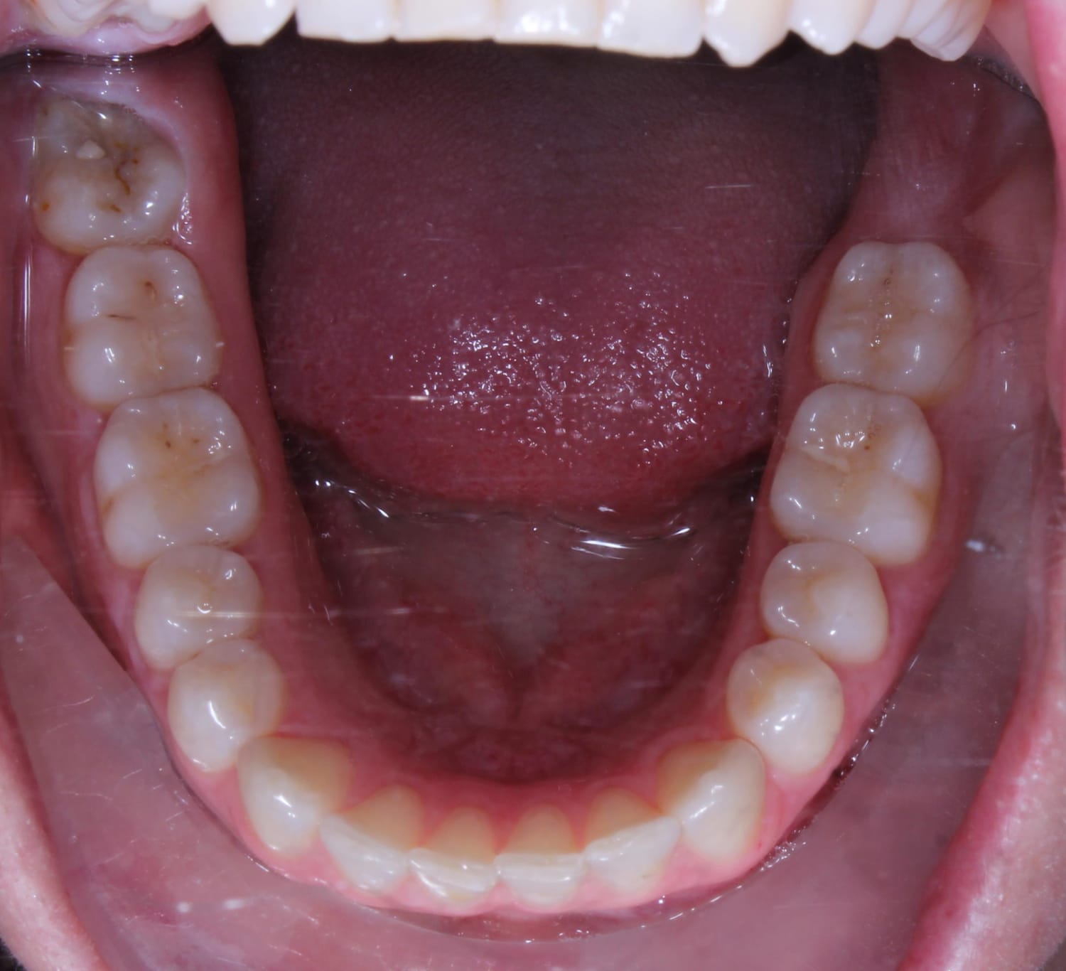 Intraoral photo — lower arch